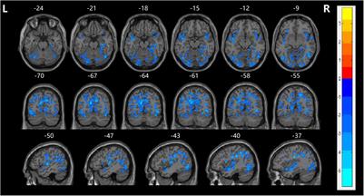 Aberrant Functional Connectivity of the Orbitofrontal Cortex Is Associated With Excited Symptoms in First-Episode Drug-Naïve Patients With Schizophrenia